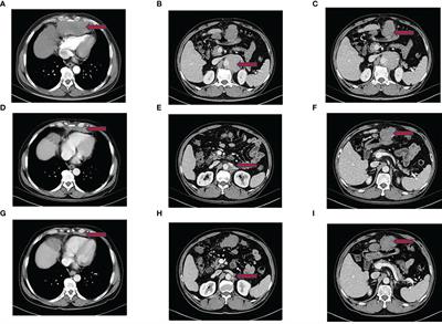 Tislelizumab immunotherapy combined with chemotherapy in the treatment of a patient with primary anterior mediastinal undifferentiated pleomorphic sarcoma with high PD-L1 expression: A case report and literature review
